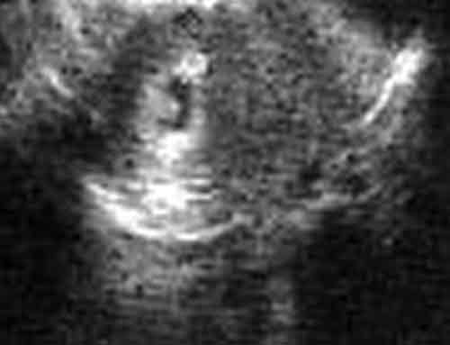baby ultrasound images - week 5