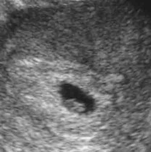 baby ultrasound images - week 6