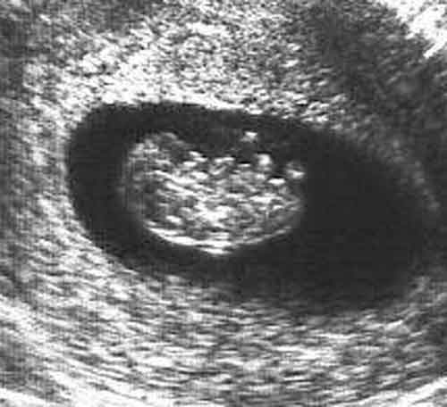 baby ultrasound images - 8 weeks