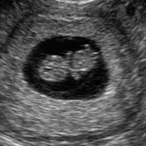 baby ultrasound images - week 9