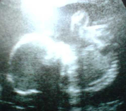 baby ultrasound images - 22-weeks-5-days