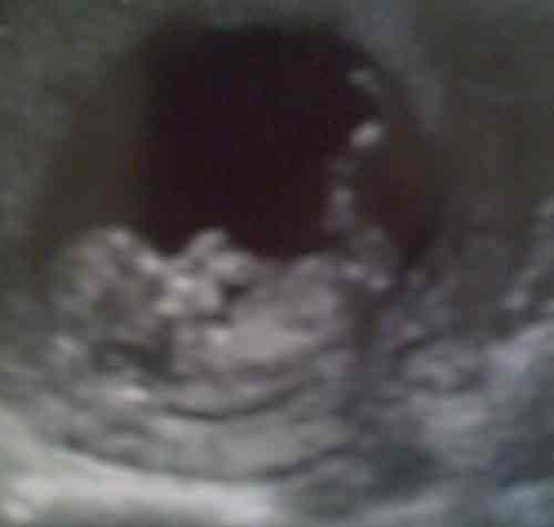 baby ultrasound images - week 12
