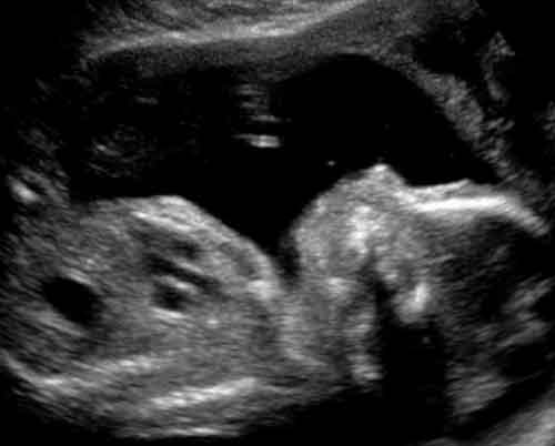 baby ultrasound images - week 20