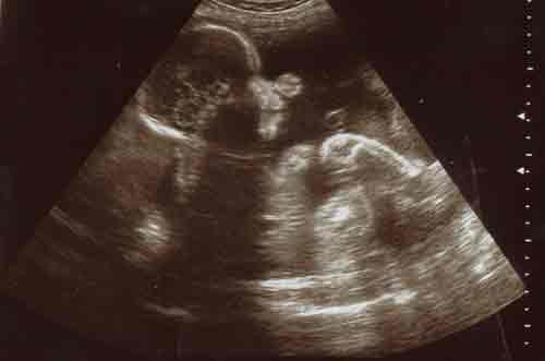 baby ultrasound images - week 23