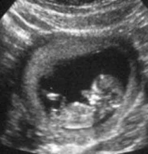 baby ultrasound images - week 11
